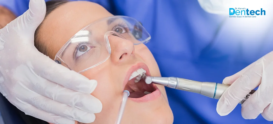Root Canal Treatment in Thane at Dr. Karve's Dentech